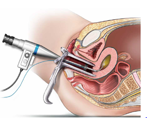 hysteroscopy diagram