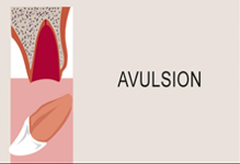 Avulsion