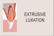 Extrusive luxation