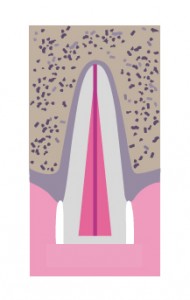 Illustration of uncomplicated crown fracture